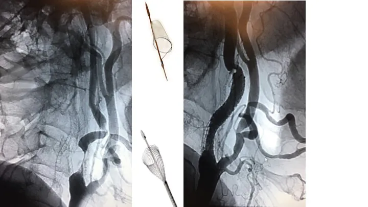 carotida